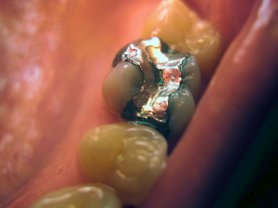 Amalgam
